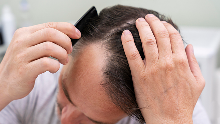 <a href='https://www.freepik.com/photos/hair-loss?0d907awf0j'>Hair loss photo created by freepik - www.freepik.com</a>